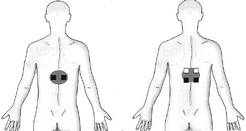 placement pain electrode upper tens lower